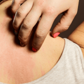 How to Recognize Bed Bug Bites