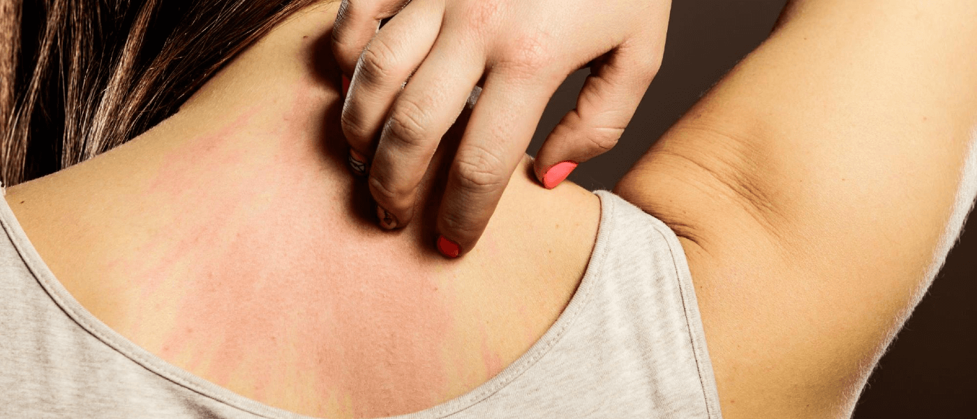 How to Recognize Bed Bug Bites