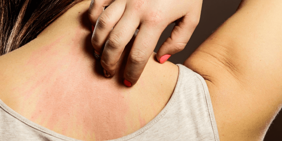 How to Recognize Bed Bug Bites